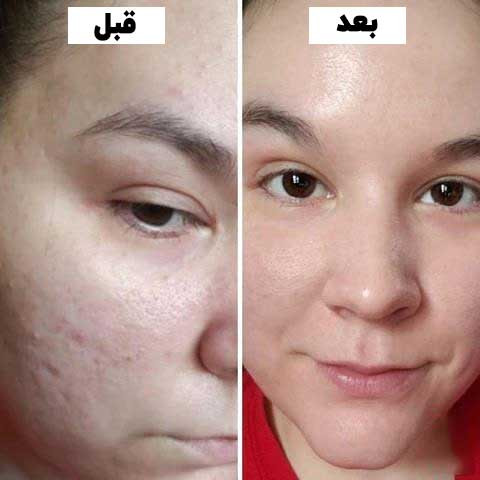 سرم لایه بردار پیلینگ سلوشن AHA و BHA اوردینری حجم 30 میل